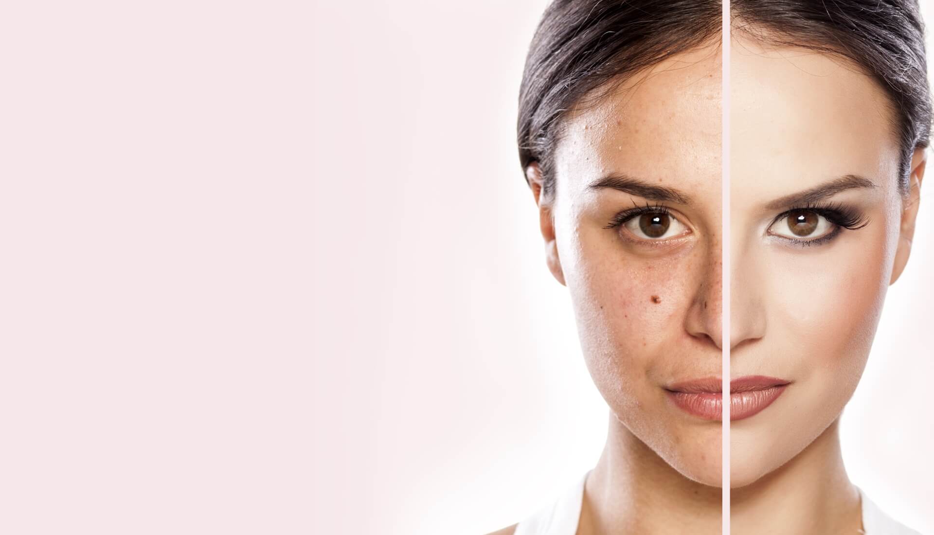 Acne scarring